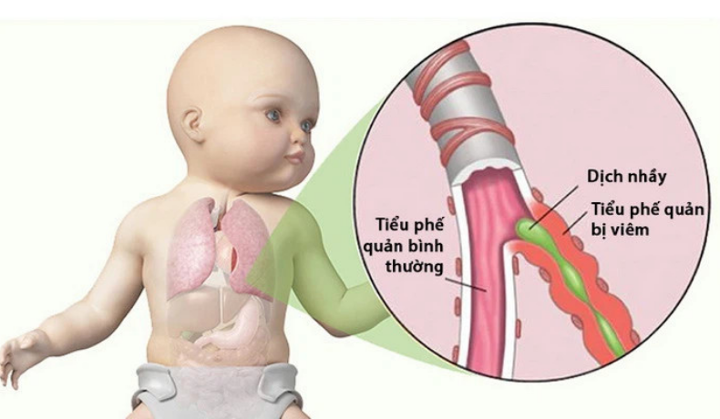 Phòng ngừa viêm tiểu phế quản ở trẻ em