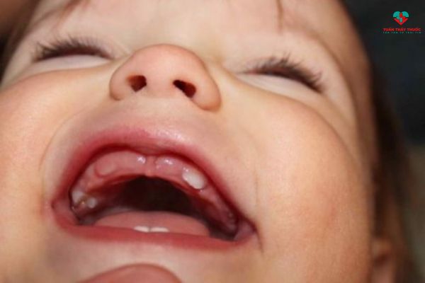 thời kỳ bé mọc răng hàm khiến bé mọc răng biếng ăn