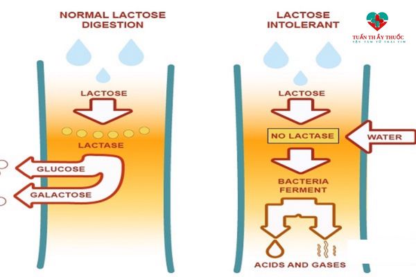 Sản phẩm trị bất dung nạp đường lactose ở trẻ