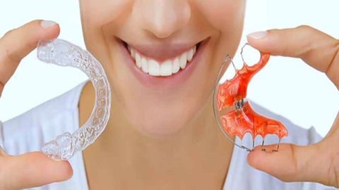 Những điều cần biết về các loại hàm duy trì sau khi niềng răng