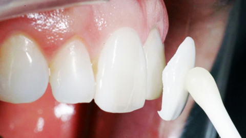 Những điều bạn cần biết trước khi dán răng sứ veneer