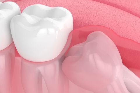 Các kiểu răng khôn mọc lệch và cách vệ sinh sau khi nhổ