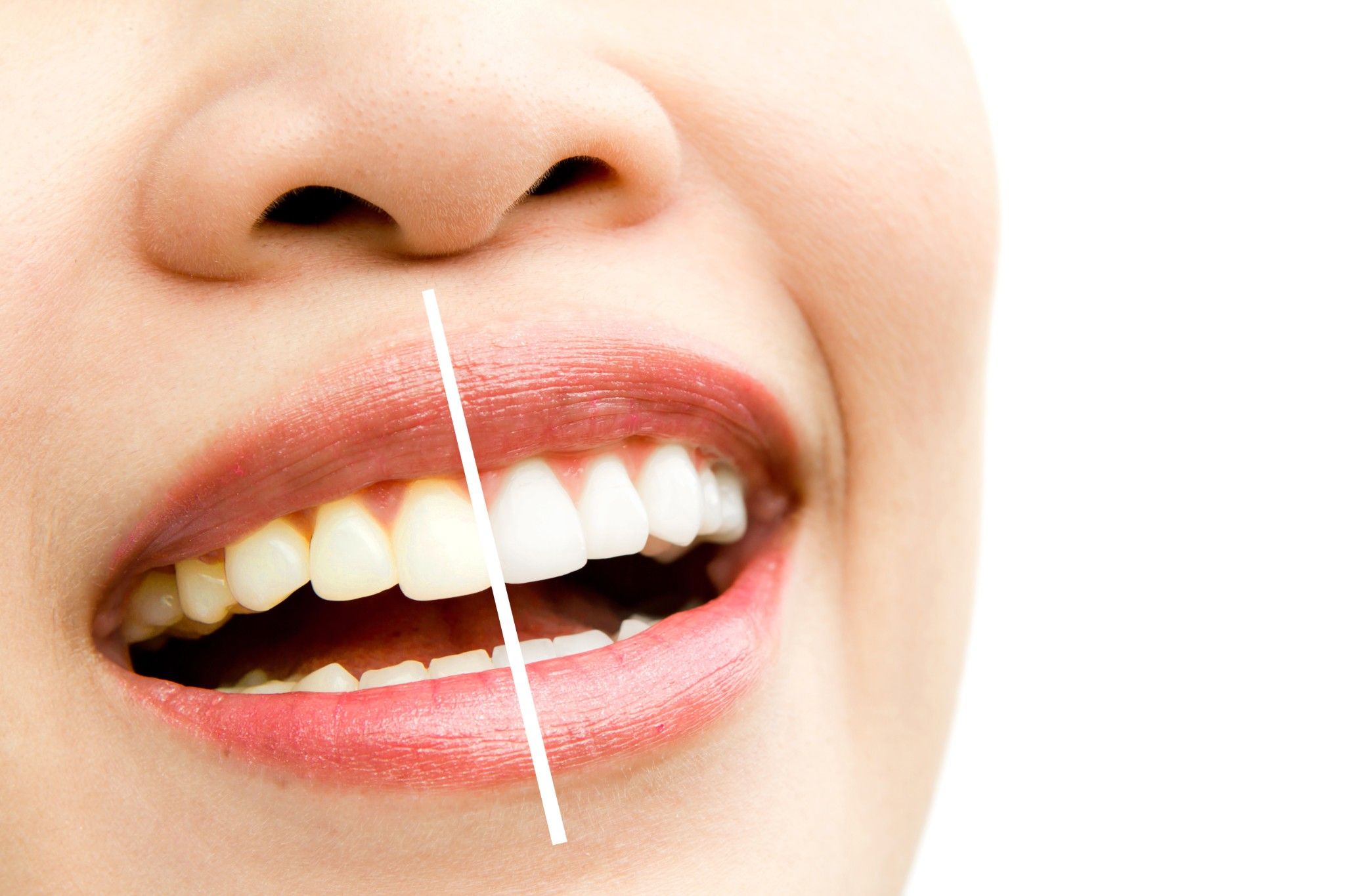 6 cách đơn giản tẩy trắng, làm trắng răng tự nhiên tại nhà – Aquapulse