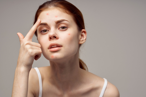 3 Lý Do Khiến Mụn Tái Đi Tái Lại Chưa Hồi Kết!?