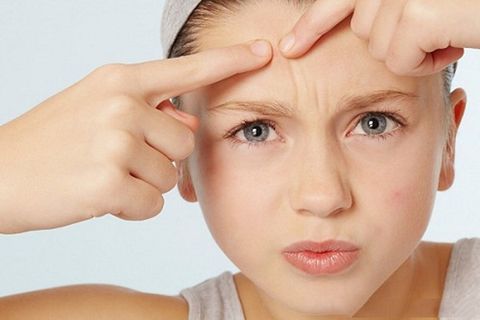 Một số cách trị mụn đầu đen ở trán đơn giản