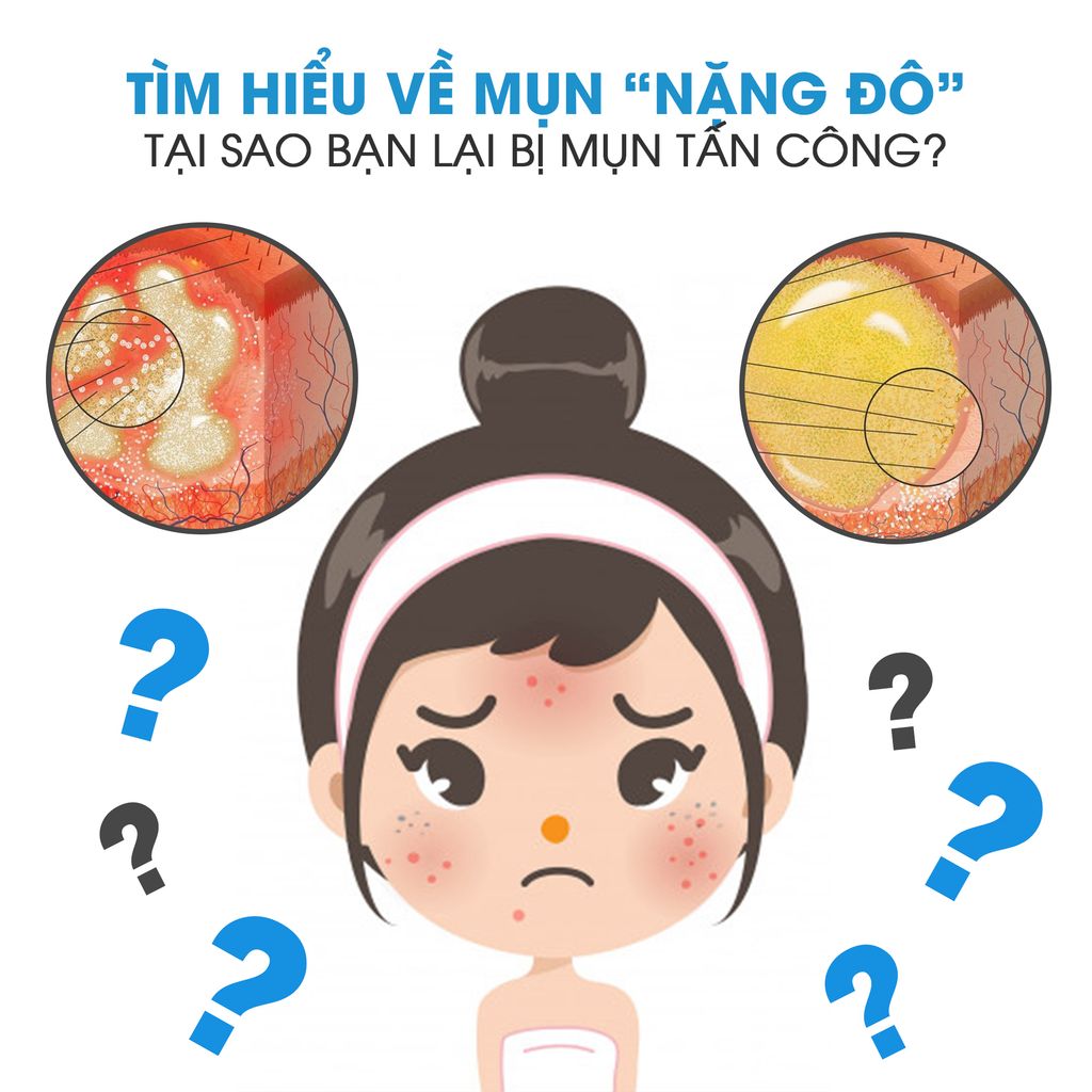 NÀNG NÀO BỊ MỤN “NẶNG ĐÔ” CẦN BIẾT NHỮNG THÔNG TIN SAU ĐỂ DA KHÔNG TỆ HƠN NỮA