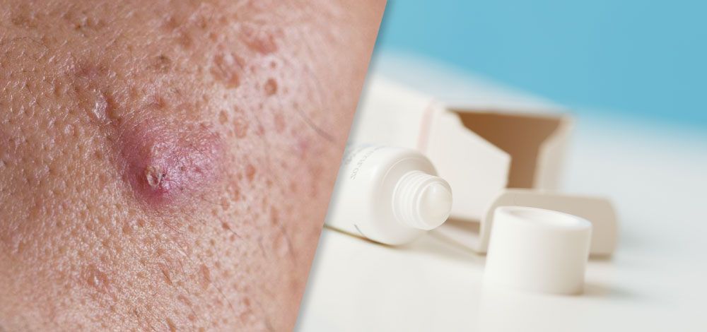 HOẠT CHẤT THẦN KỲ RETINOIDS – “SIÊU ANH HÙNG” GIÚP GIẢM MỤN MỜ THÂM