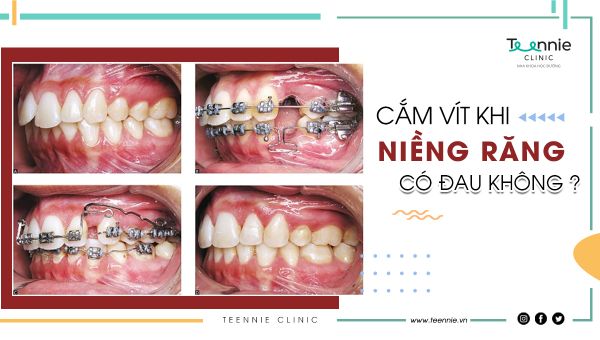 Cắm vít khi niềng răng có đau không?