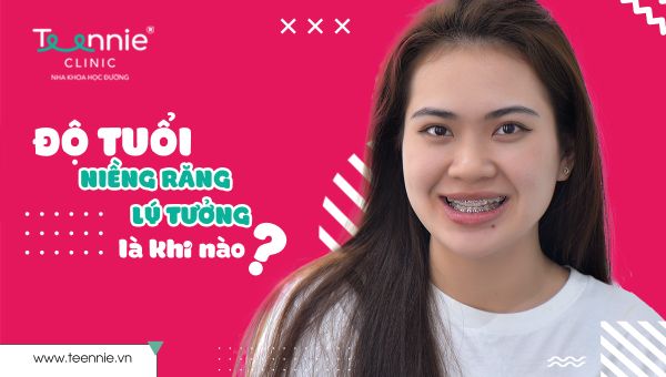 Độ tuổi niềng răng lý tưởng là khi nào?