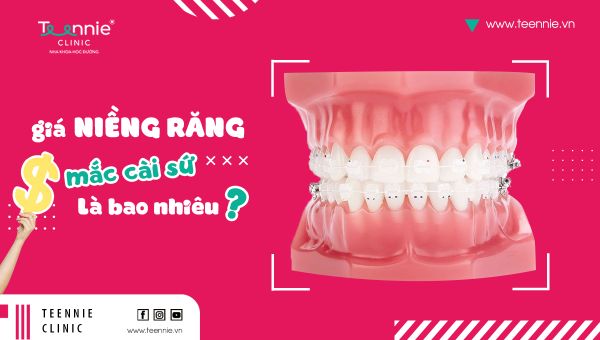 Giá niềng răng mắc cài sứ là bao nhiêu?