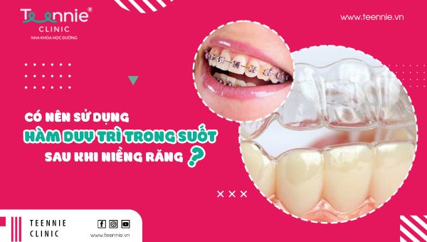 Có nên sử dụng hàm duy trì trong suốt sau khi niềng răng ?