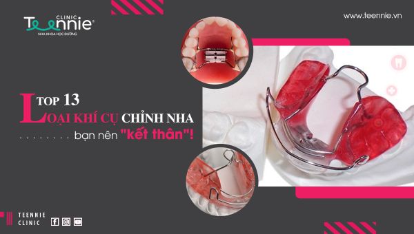 TOP 13 loại khí cụ chỉnh nha tốt nhất bạn nên