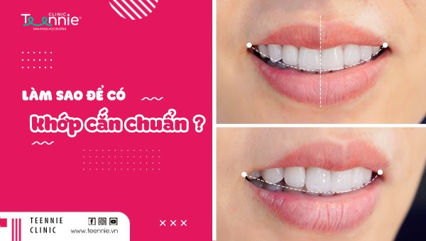 Thế nào là khớp cắn chuẩn? Làm sao để có khớp cắn răng chuẩn?