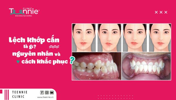 Lệch khớp cắn là gì? Nguyên nhân và cách khắc phục hiệu quả!