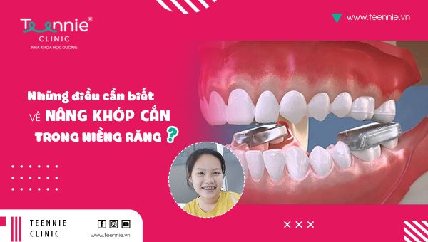 Những điều cần biết về nâng khớp cắn trong niềng răng!
