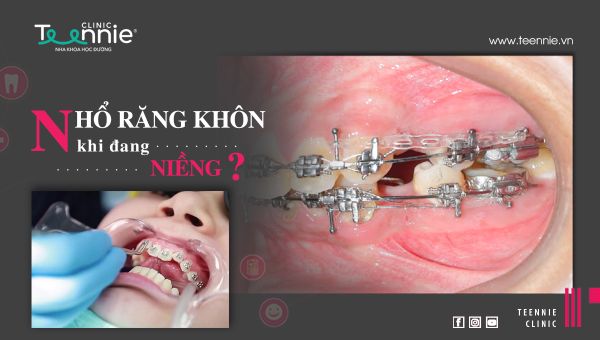 Có nên nhổ răng khôn khi đang niềng răng không?