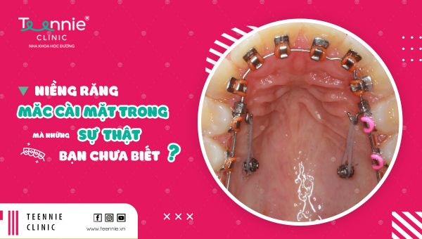 Niềng răng mắc cài mặt trong và những sự thật bạn chưa biết!
