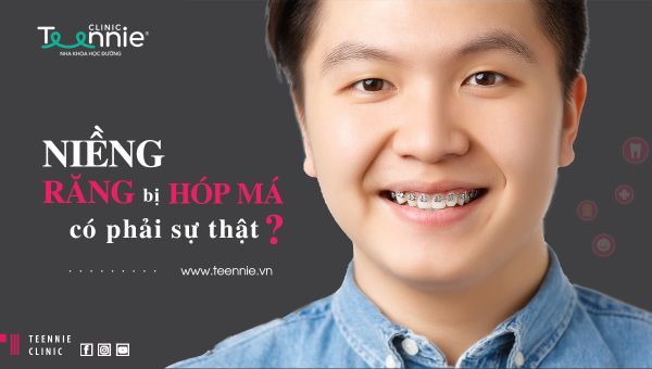 Niềng răng bị hóp má và những sự thật bạn cần biết!