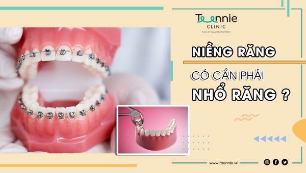 Niềng răng có cần phải nhổ răng không?