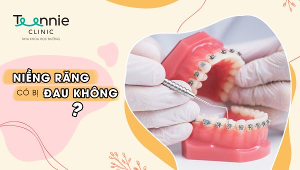 Niềng răng có đau không? Giải đáp từ chuyên gia