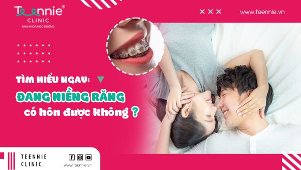 Tìm hiểu ngay: Đang niềng răng có hôn được không?