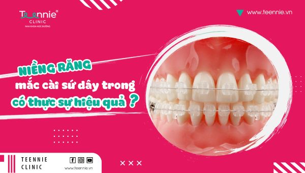 Niềng răng mắc cài sứ dây trong có thực sự hiệu quả?