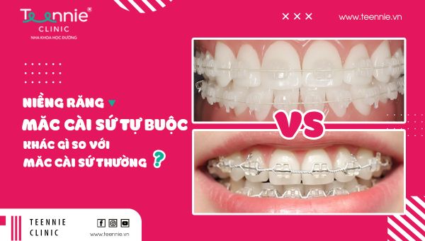 Niềng răng mắc cài sứ tự buộc khác gì so với mắc cài sứ thường?