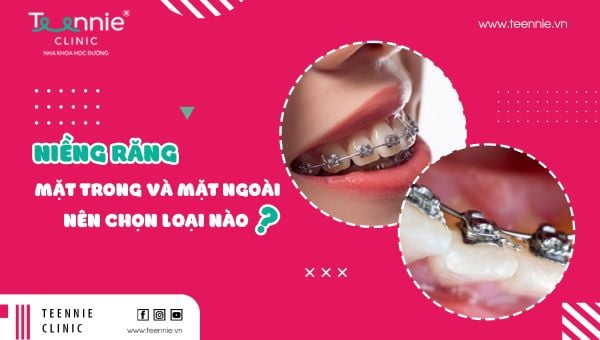 Niềng răng mặt trong và mặt ngoài nên chọn loại nào?