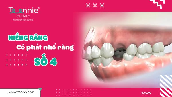 Niềng răng có cần thiết phải nhổ răng số 4?