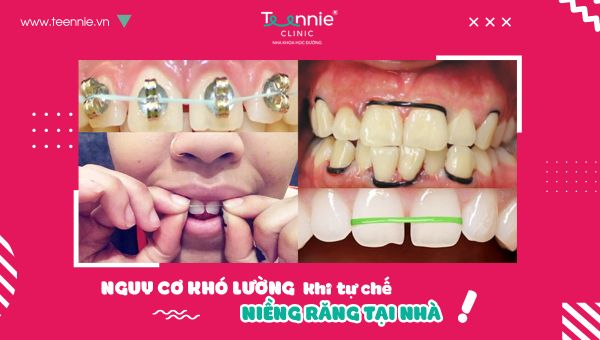 Những nguy cơ khó lường khi tự chế niềng răng tại nhà!