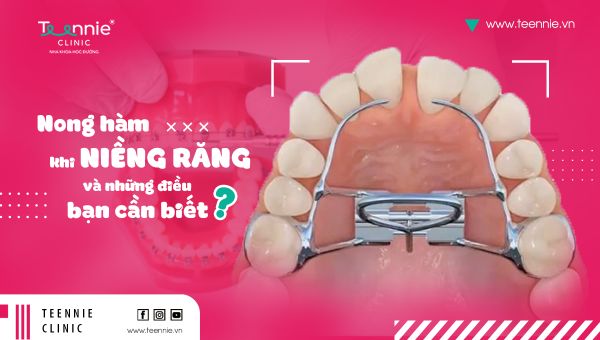 Nong hàm khi niềng răng và những điều bạn cần biết!
