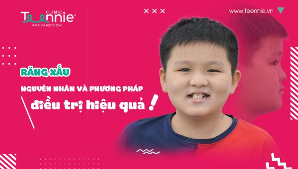 Răng xấu - Nguyên nhân và phương pháp điều trị hiệu quả!