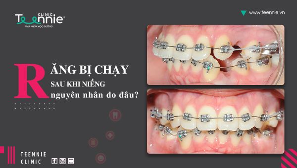 Răng bị chạy sau khi niềng nguyên nhân do đâu?