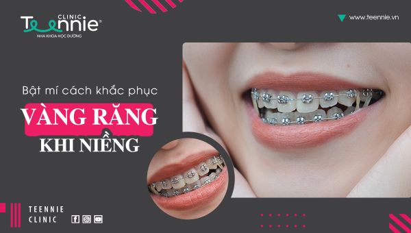 Răng bị vàng khi niềng làm cách nào để khắc phục?