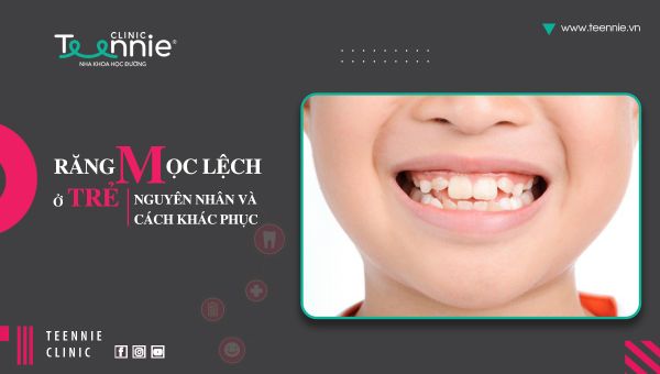 Răng mọc lệch ở trẻ: Nguyên nhân và cách khắc phục!