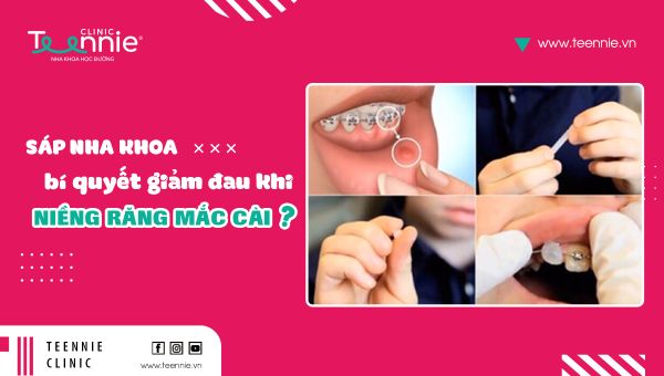 Sáp nha khoa - Bí quyết giảm đau khi niềng răng mắc cài!
