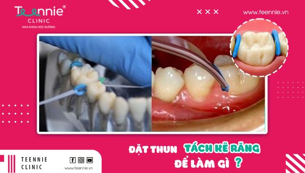 Đặt thun tách kẽ răng để làm gì? Có thực sự cần thiết?