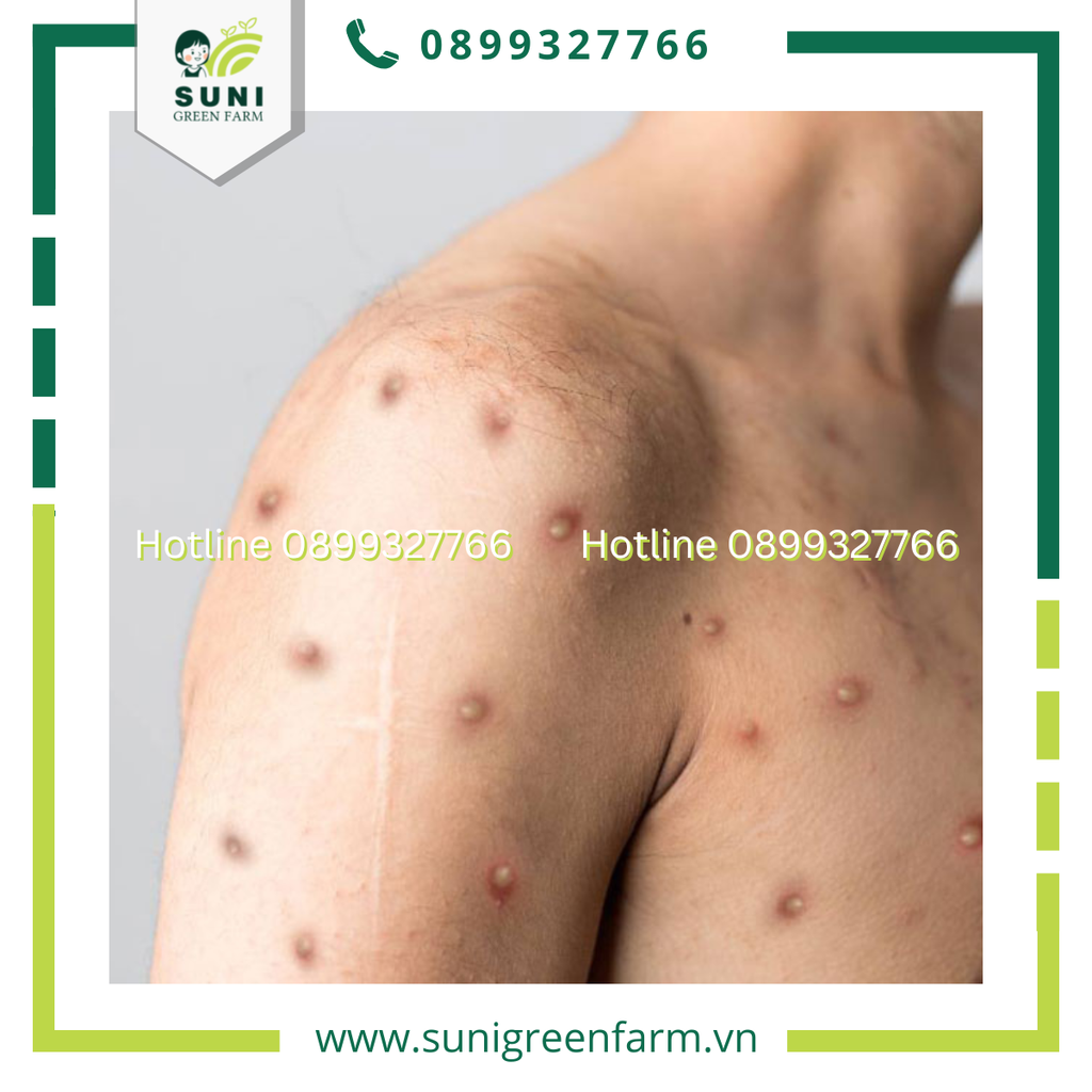 BỆNH ĐẬU MÙA KHỈ LÀ GÌ? CHÚNG TA NÊN CHUẨN BỊ GÌ ĐỂ ĐỐI PHÓ VỚI LOẠI BỆNH NÀY