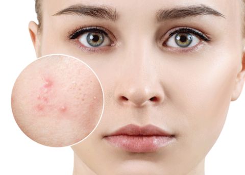Các bước skincare cơ bản cho da dầu để làn da khoẻ mạnh