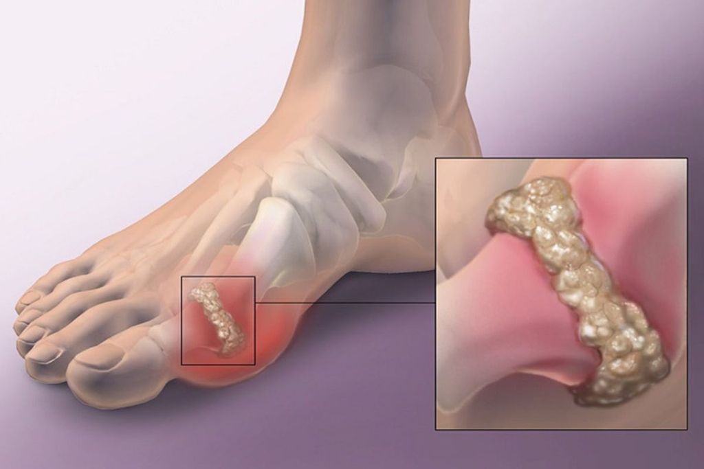 dấu hiệu đau ngón chân cái