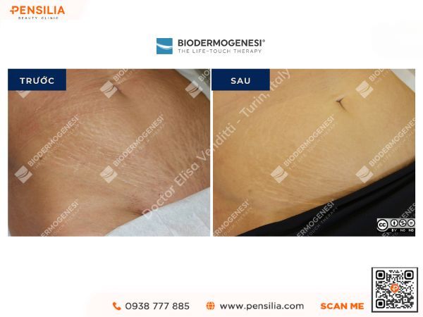 kem-ran-da-truoc-sau