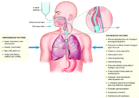 Vấn đề viêm phổi (VAP) trên bệnh nhân thông khí nhân tạo