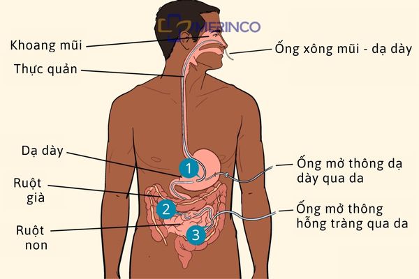Các loại ống nuôi ăn và mẹo chăm sóc ống nuôi ăn