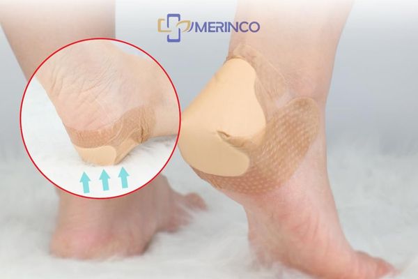 Tìm hiểu các loại loét da