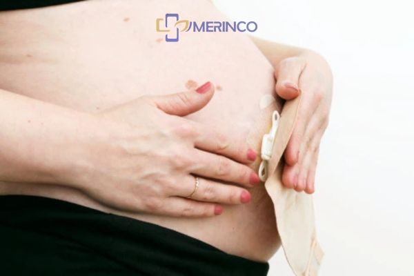 Hậu môn nhân tạo ảnh hưởng đến thai kỳ không?