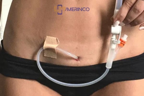 Ống thông tiểu dài ngày là gì? Có mấy loại?