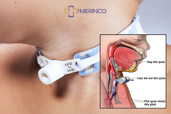 Phân biệt giữa đặt nội khí quản và mở khí quản: Bạn đã biết chưa?