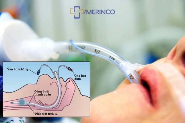 Phân biệt giữa đặt nội khí quản và mở khí quản: Bạn đã biết chưa?