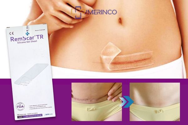 Một miếng dán ép sẹo RemScar size 3.5x15cm xài được bao lâu?