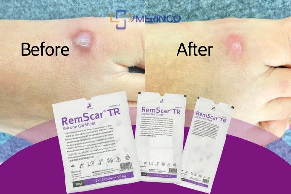 Miếng dán trị sẹo RemScar sao lại dán được lâu vậy?
